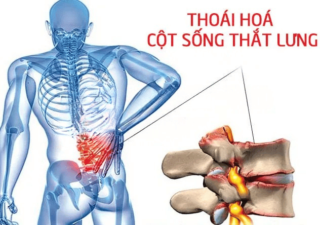 5 MỐI NGUY TỪ CÁC CƠN ĐAU THẮT LƯNG 1 5 MỐI NGUY TỪ CÁC CƠN ĐAU THẮT LƯNG 1