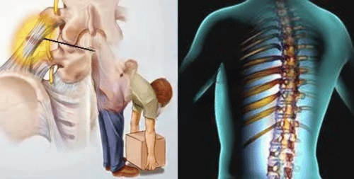 5 MỐI NGUY TỪ CÁC CƠN ĐAU THẮT LƯNG 2 5 MỐI NGUY TỪ CÁC CƠN ĐAU THẮT LƯNG 2