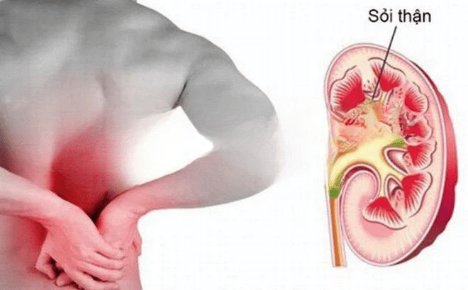 5 MỐI NGUY TỪ CÁC CƠN ĐAU THẮT LƯNG 3 5 MỐI NGUY TỪ CÁC CƠN ĐAU THẮT LƯNG 3
