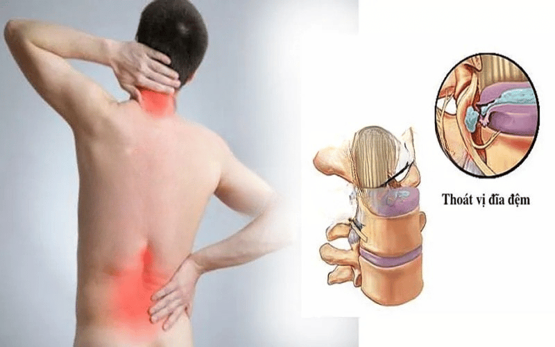5 MỐI NGUY TỪ CÁC CƠN ĐAU THẮT LƯNG 4 5 MỐI NGUY TỪ CÁC CƠN ĐAU THẮT LƯNG 4