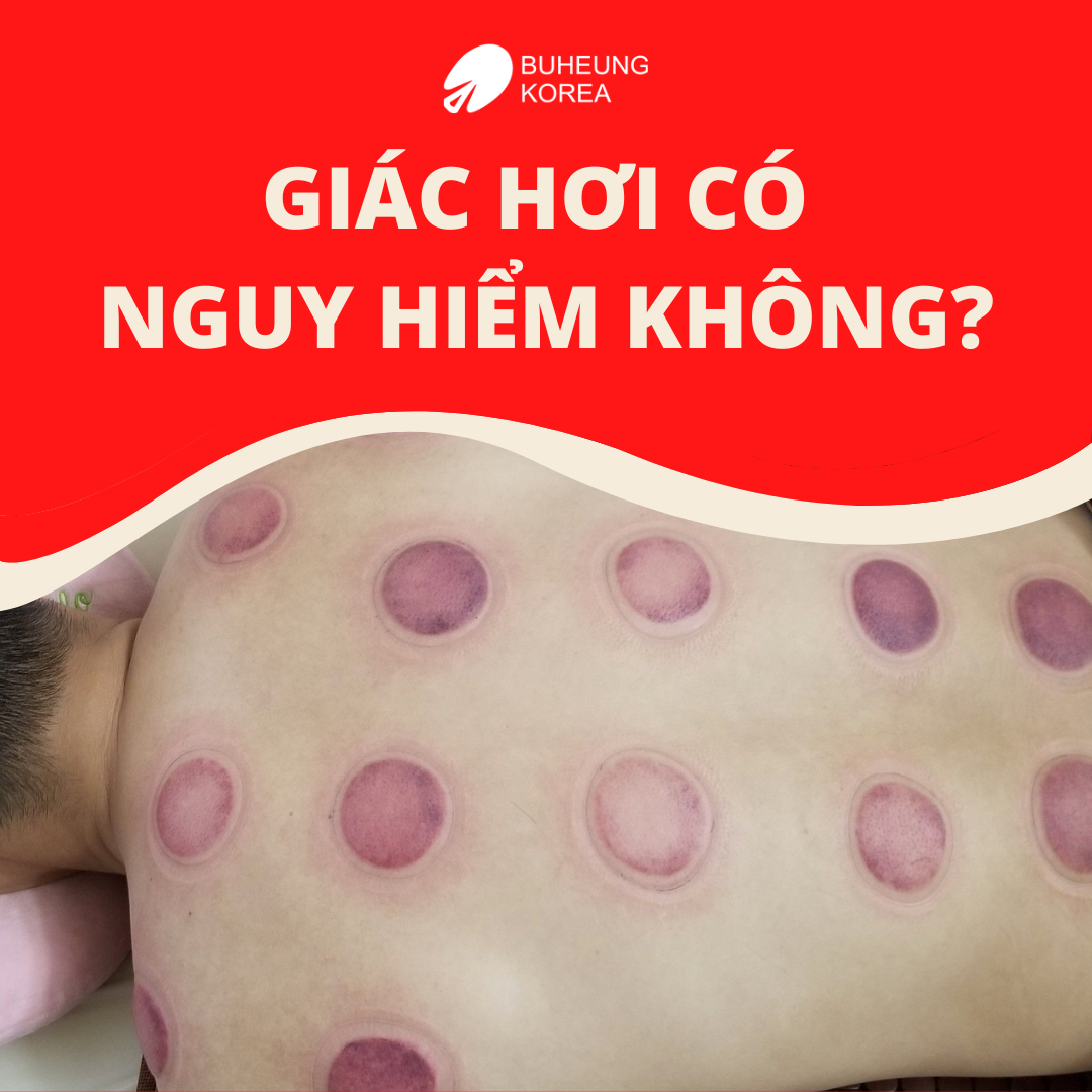 Cạo Gió Giác Hơi Là Gì: Công Dụng, Có Tốt Không 6