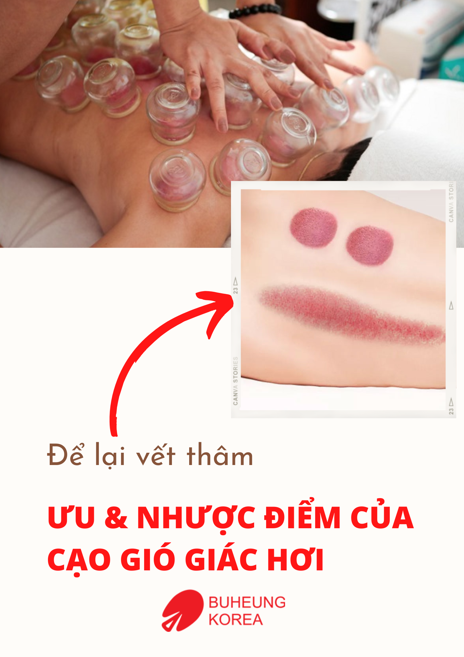 Cạo Gió Giác Hơi Là Gì: Công Dụng, Có Tốt Không 5