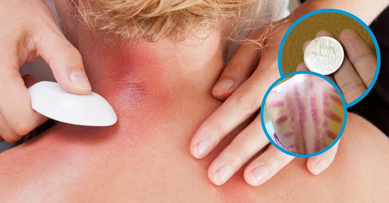 Cạo Gió Giác Hơi Là Gì: Công Dụng, Có Tốt Không 2