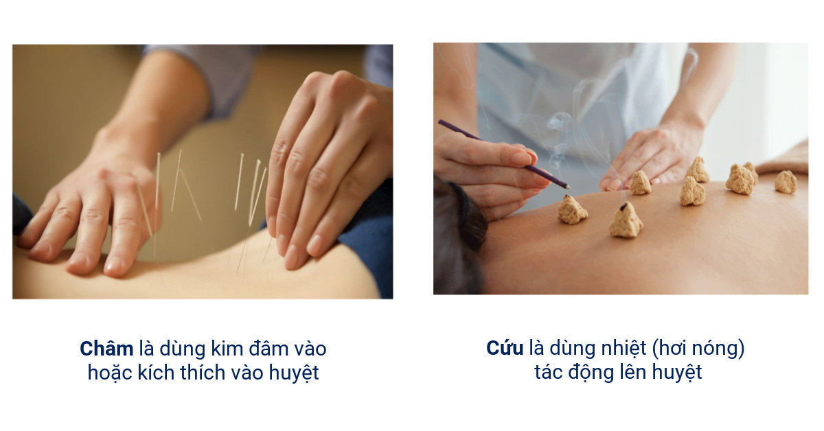 Châm Cứu Bấm Huyệt Là Gì: Công Dụng, Nhược Điểm 1