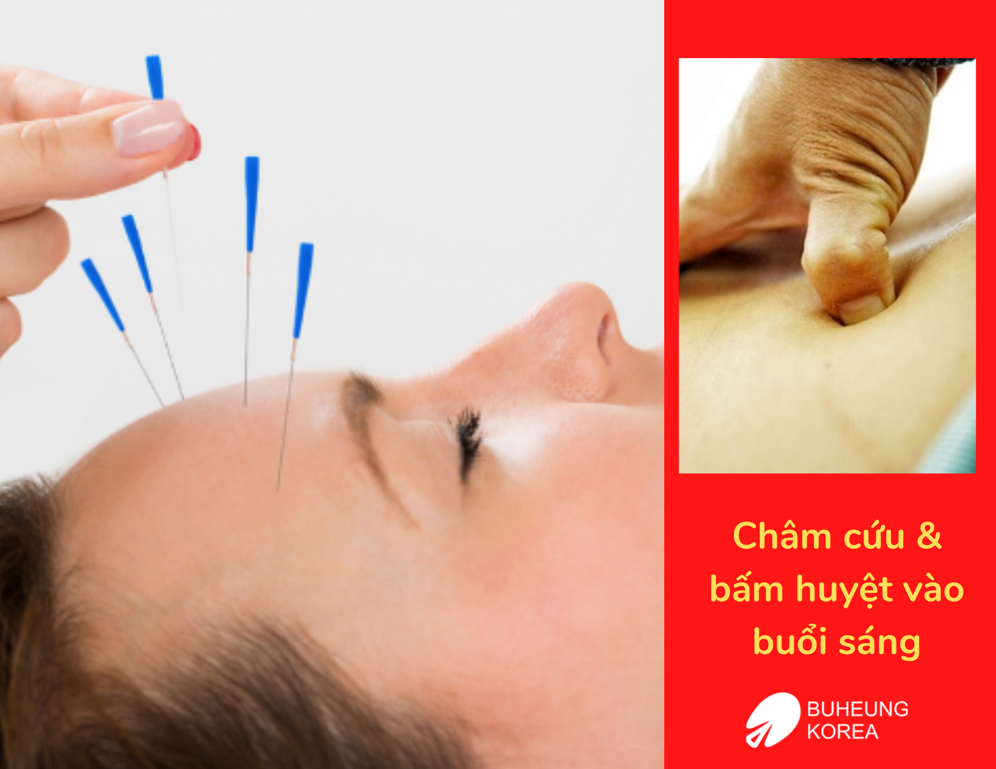 Châm Cứu Bấm Huyệt Là Gì: Công Dụng, Nhược Điểm 5