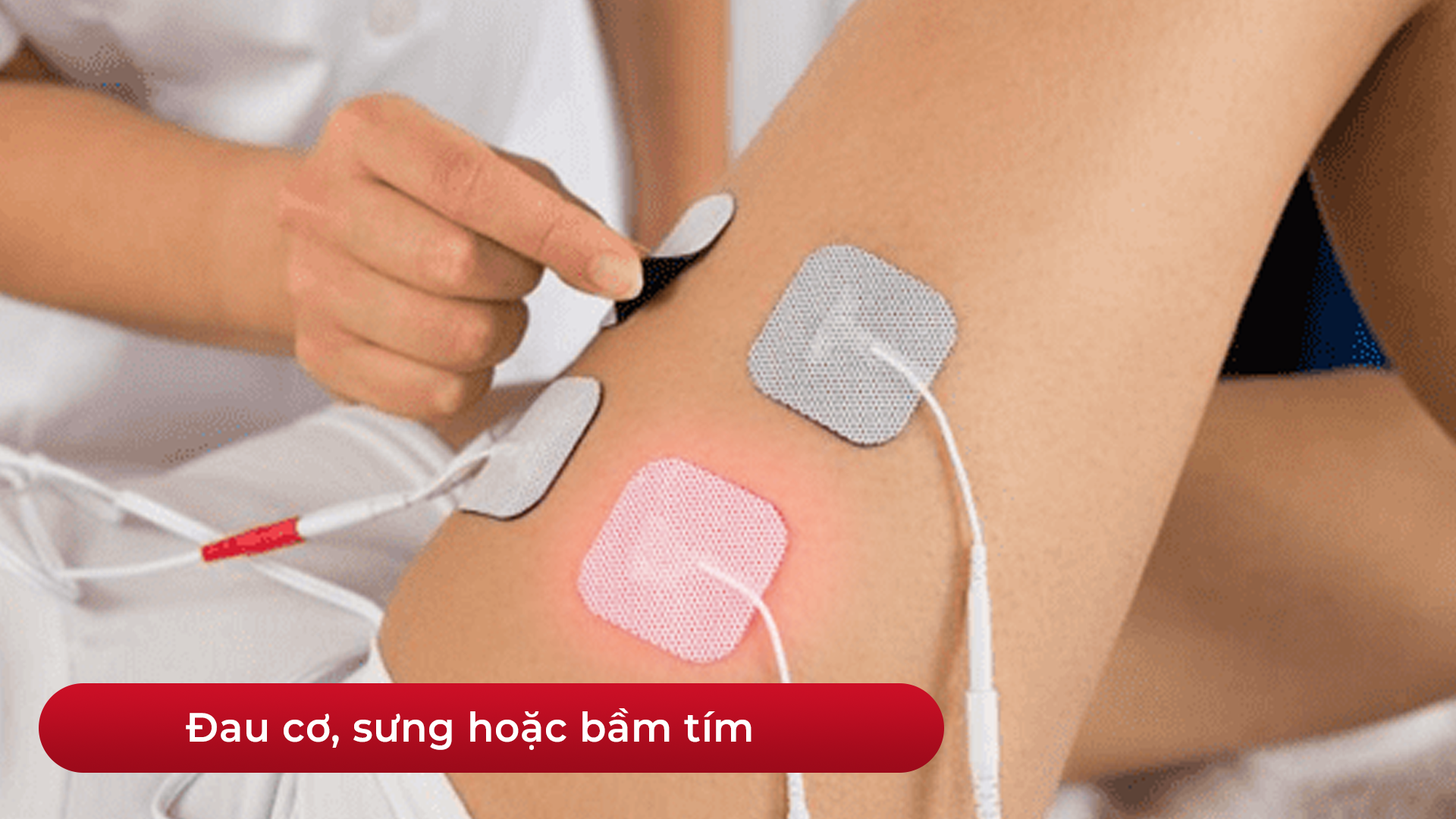 Minh họa máy xung điện có thể gây sưng và đau cơ