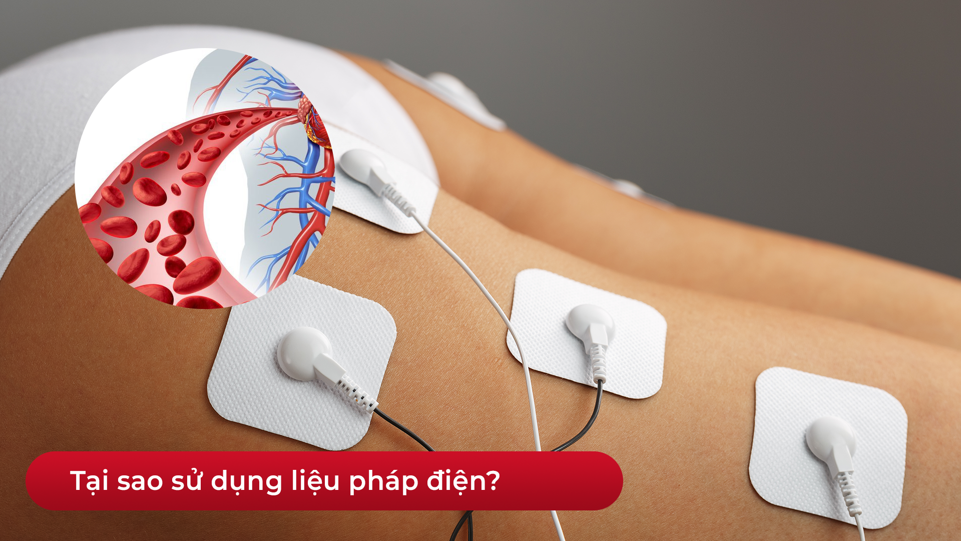 Minh họa lý do sử dụng liệu pháp điện