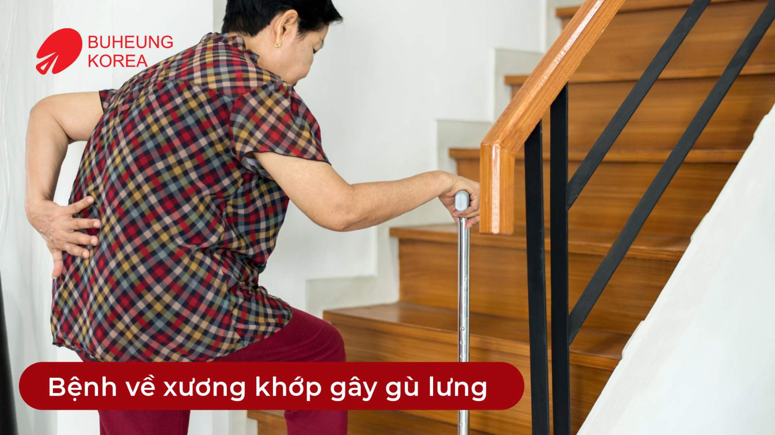 Minh họa bệnh xương khớp gây gù lưng