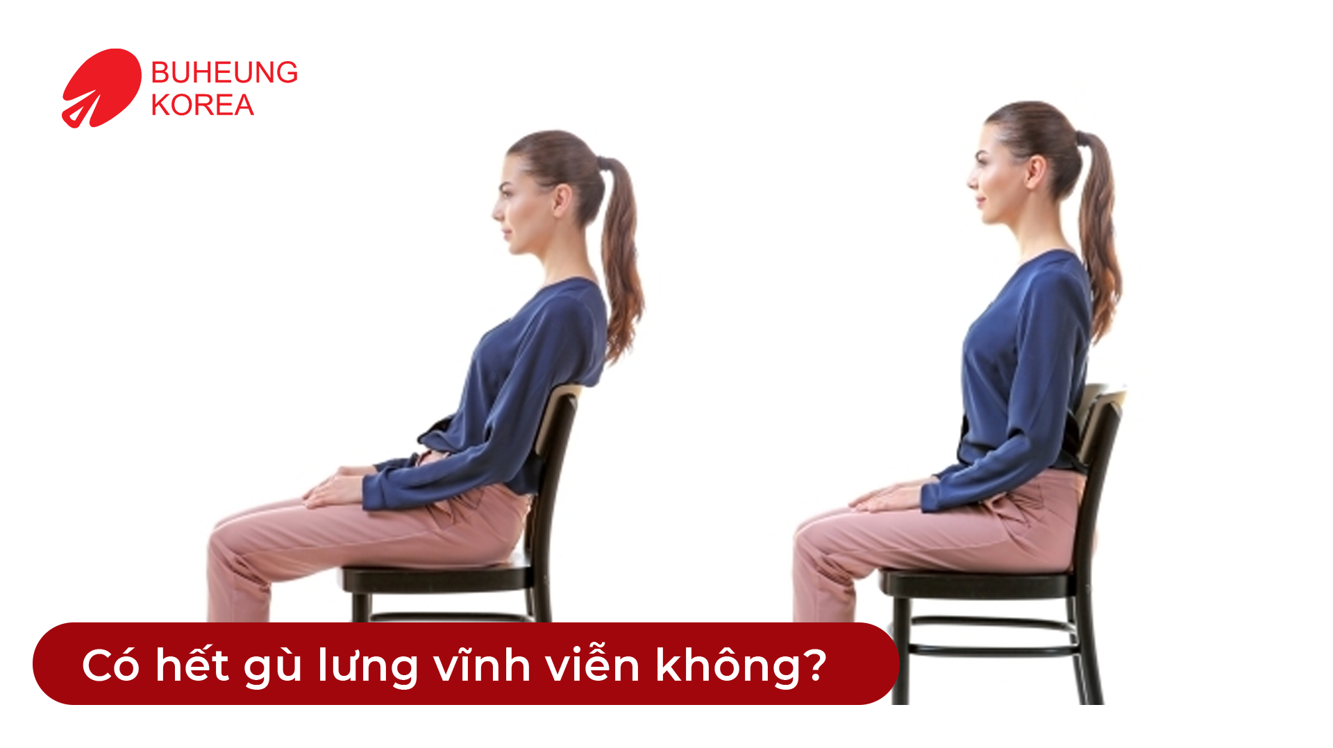 Minh họa gù lưng có hết vĩnh viễn không