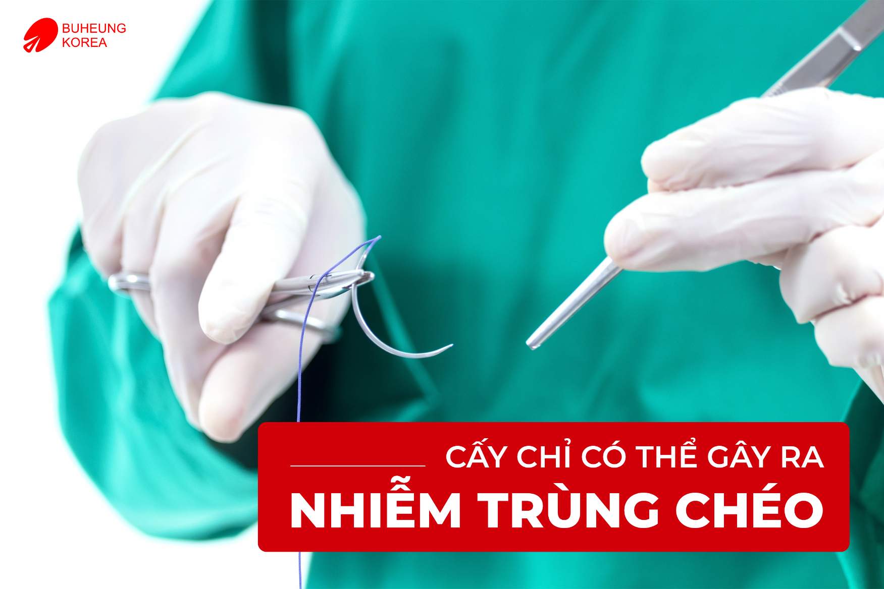 Minh họa cấy chỉ gây nhiễm trùng chéo