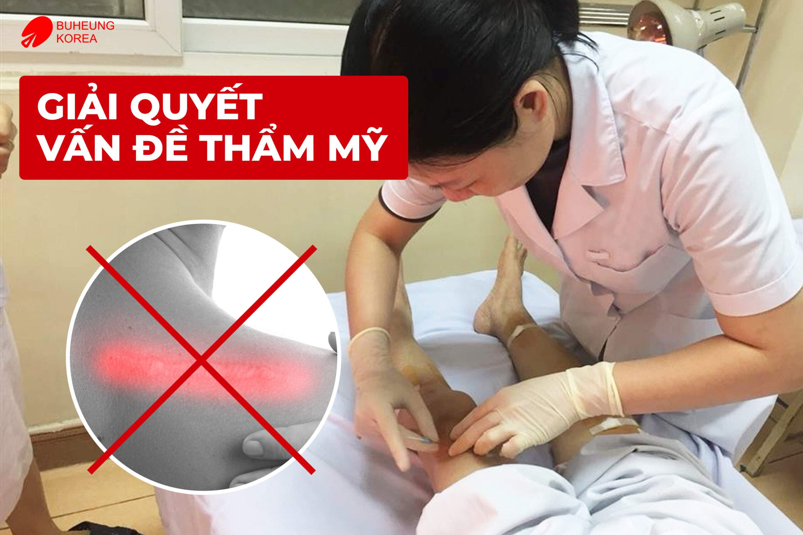 Minh họa cấy chỉ giải quyết vấn đề thẩm mỹ