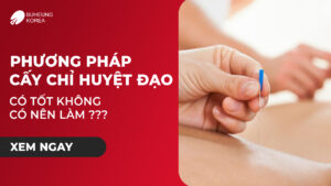 Minh họa phương pháp cấy chỉ có tốt không