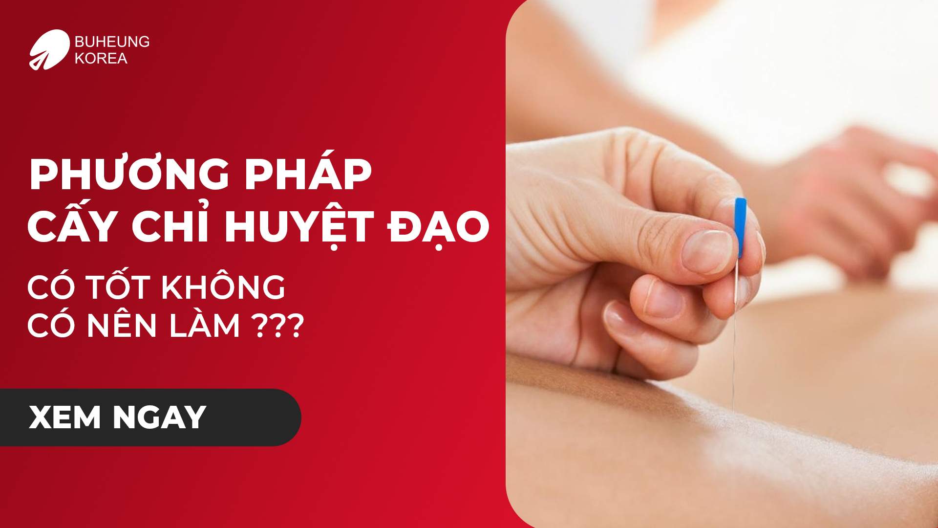 Phương Pháp Cấy Chỉ Huyệt Đạo Có Tốt Không? Có Nên Làm 1 Minh họa phương pháp cấy chỉ có tốt không
