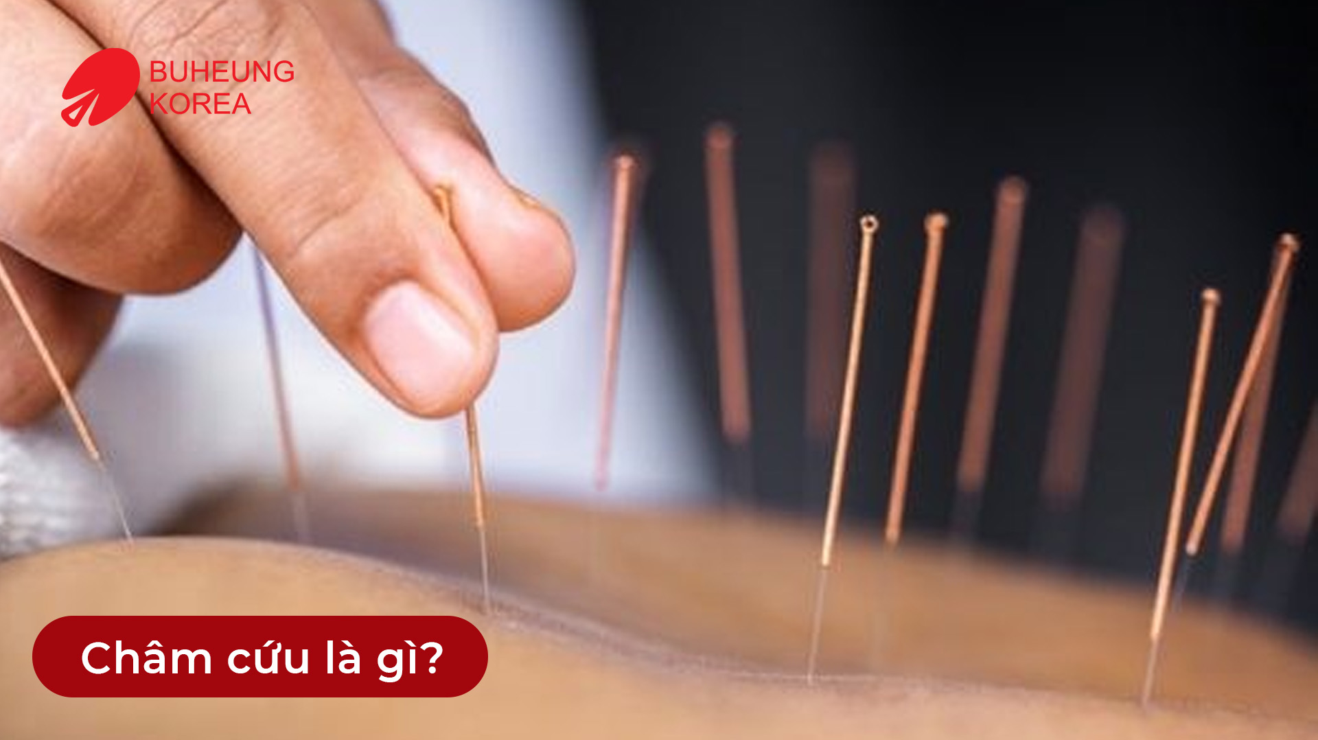 Minh họa châm cứu là gì
