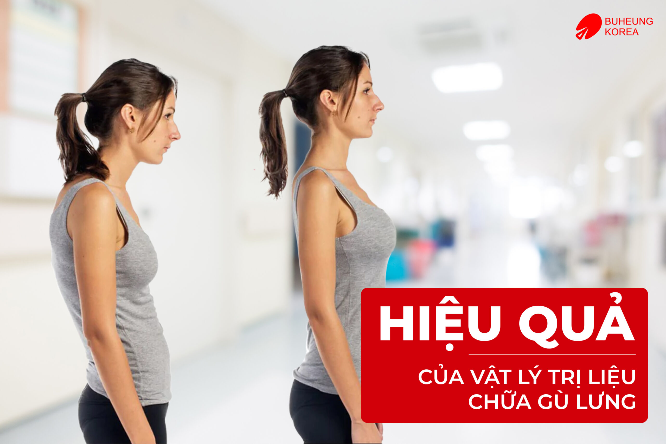 Vật Lý Trị Liệu Chữa Gù Lưng Hiệu Quả Không 2 Minh họa hiệu quả của vật lý trị liệu trong chữa gù lưng