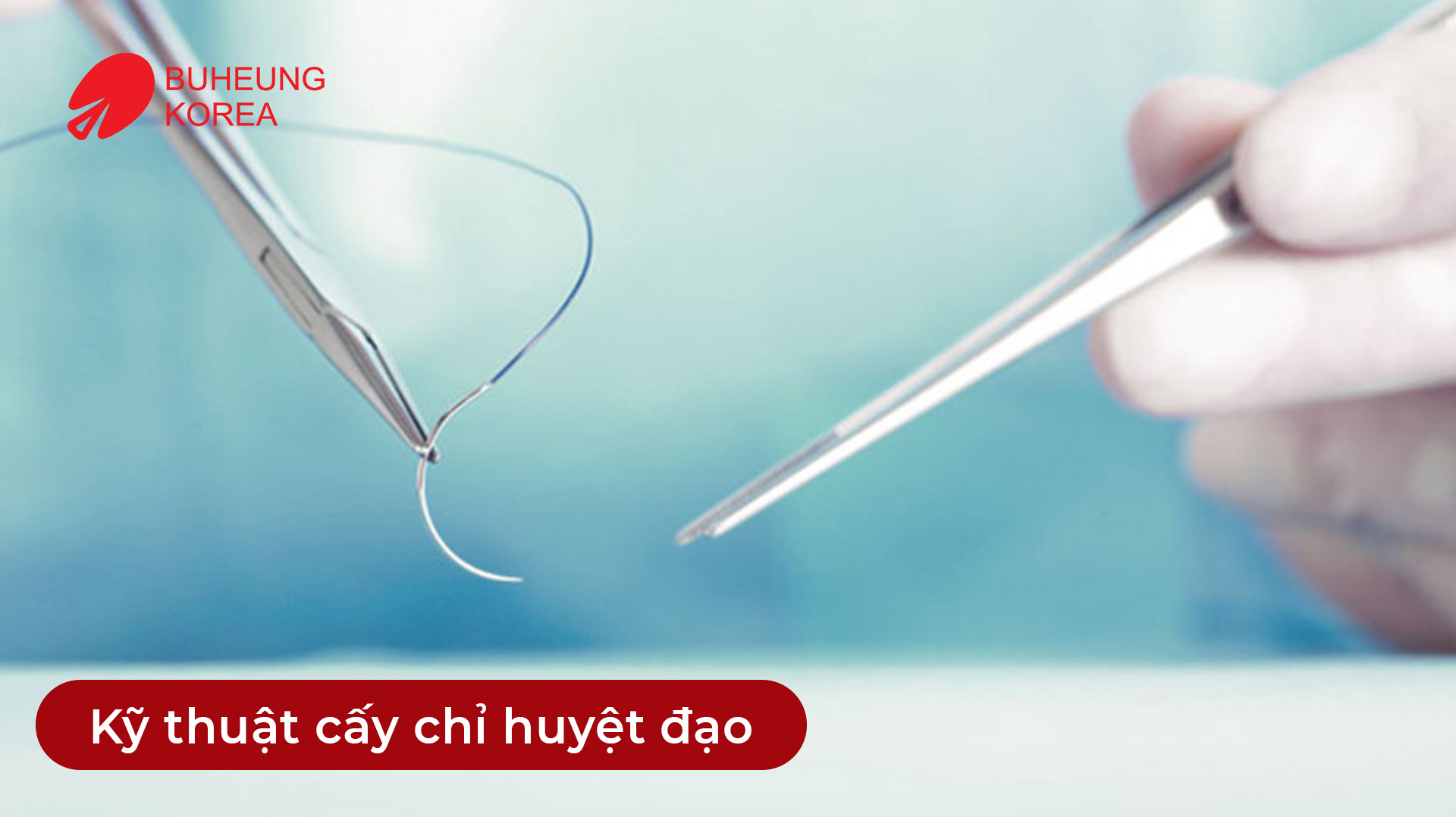 Minh họa kỹ thuật cấy chỉ huyệt đạo