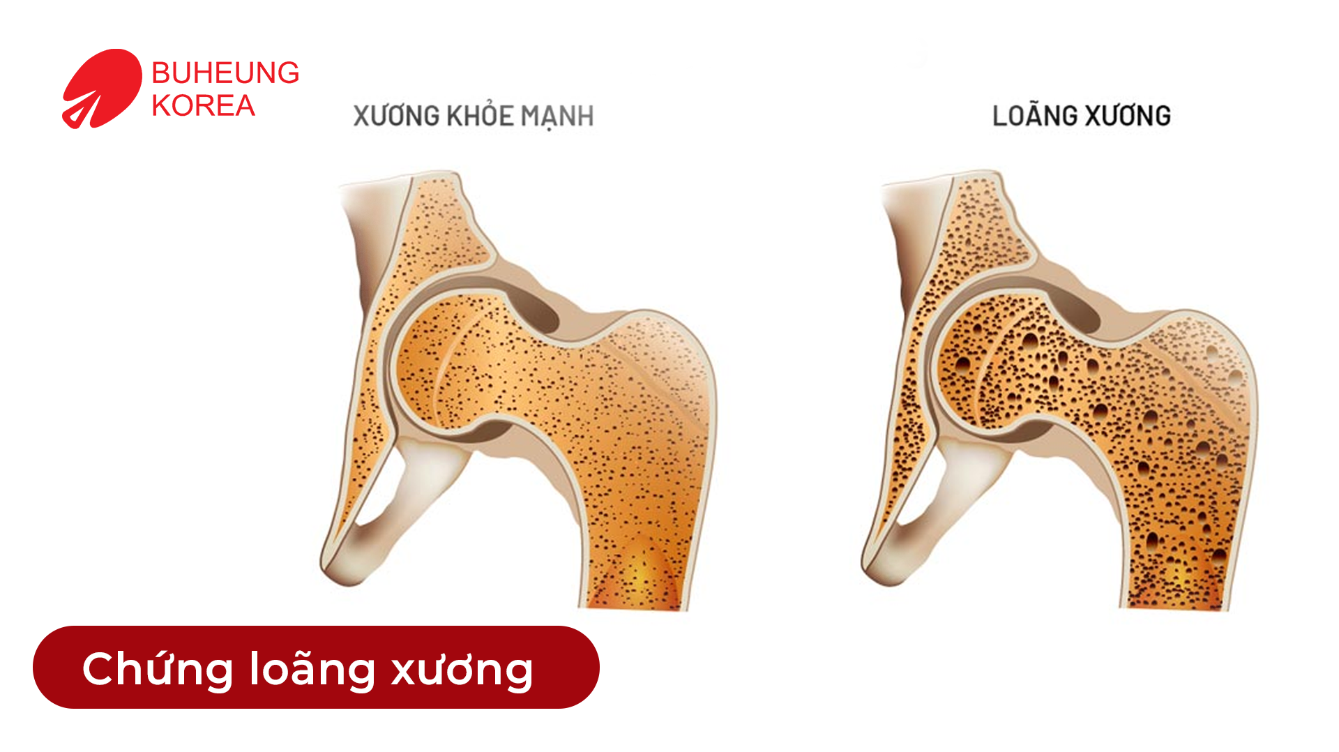 Ai Không Nên Massage Shiatsu? 13 Bệnh Lý Nên Lưu Ý 2 Minh họa người bị loãng xương không nên massage shiatsu
