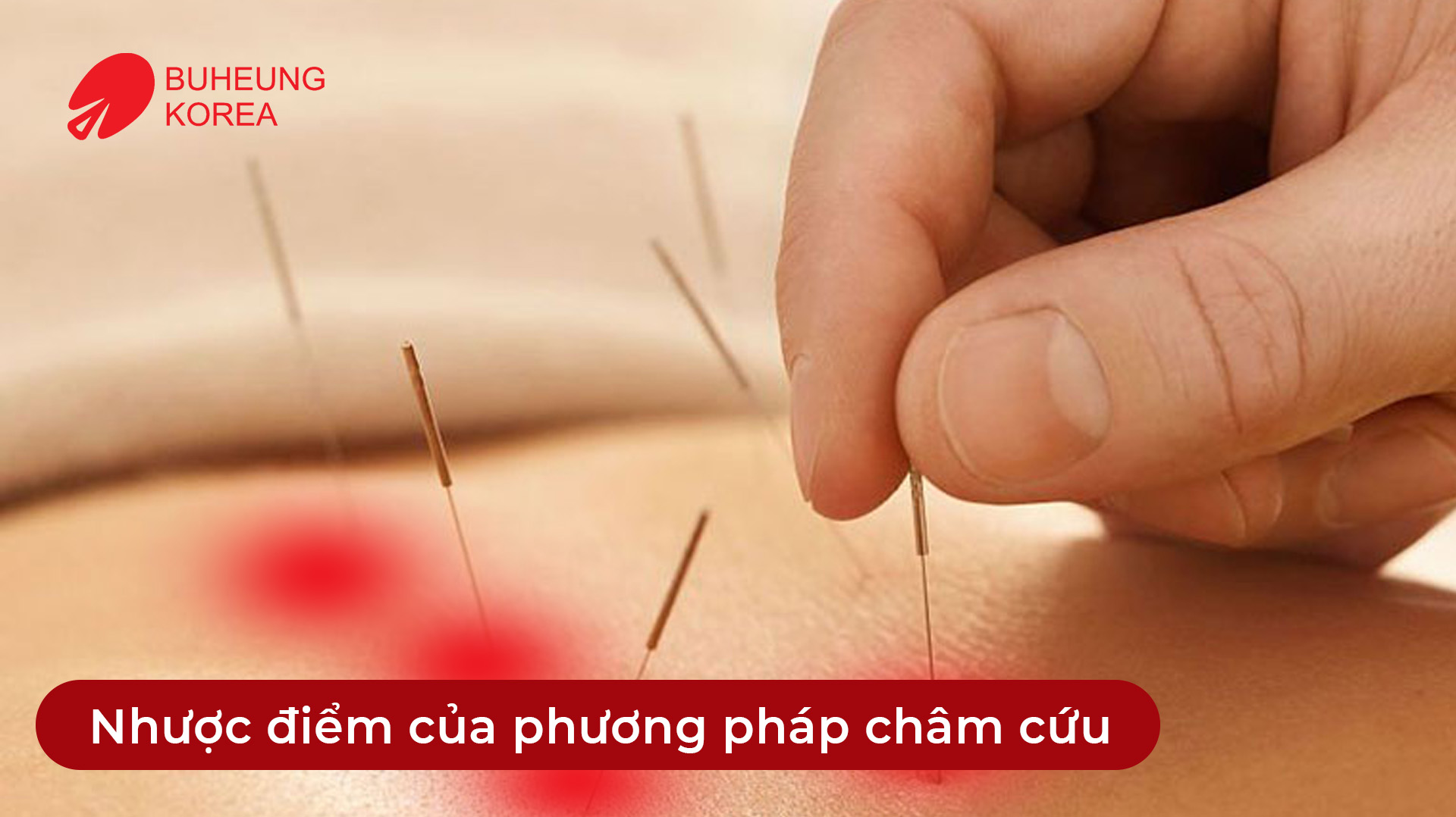 Minh họa nhược điểm của châm cứu