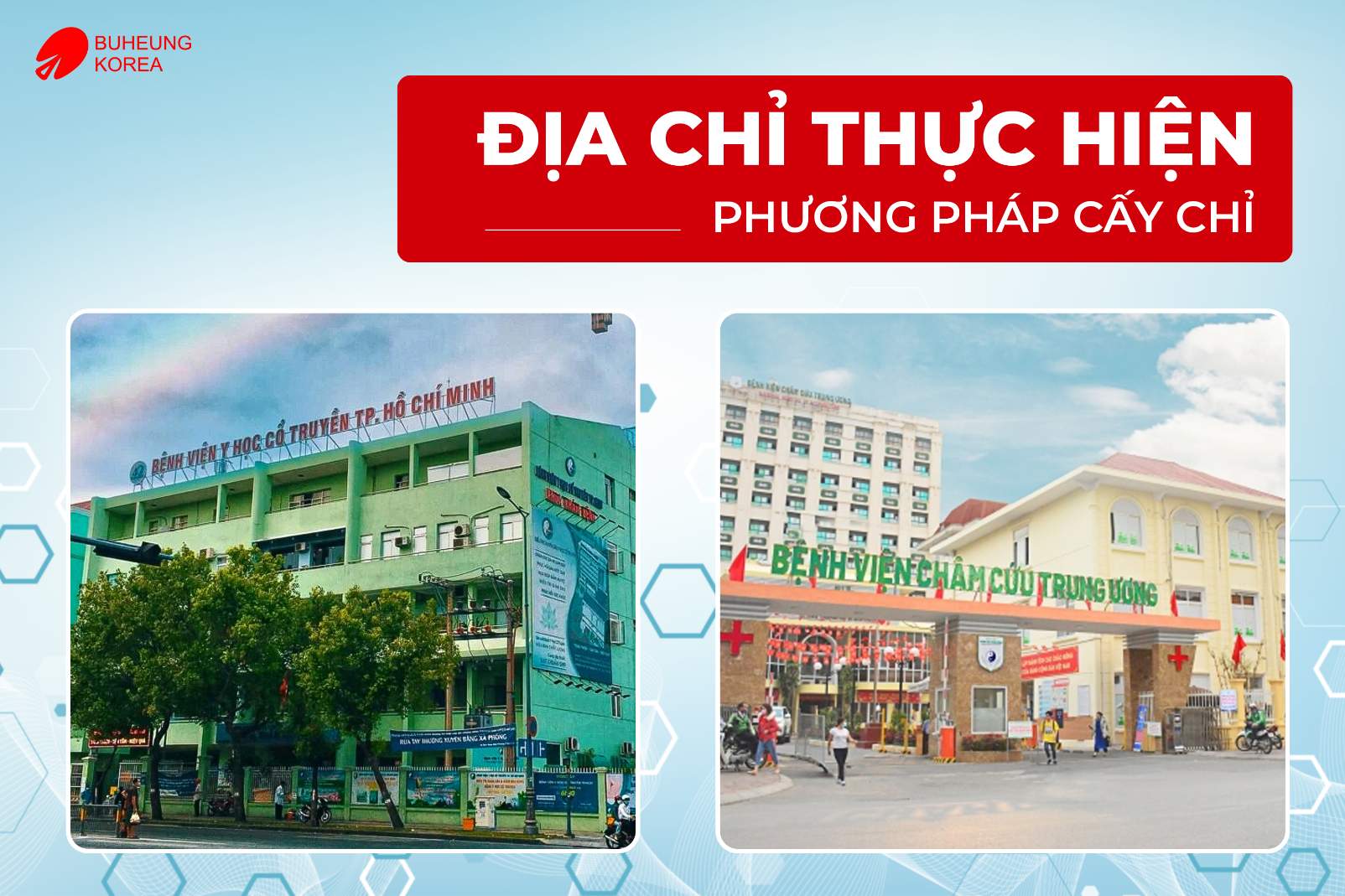 Phương Pháp Cấy Chỉ Huyệt Đạo Có Tốt Không? Có Nên Làm 5 Minh họa địa điểm thực hiện phương pháp cấy chỉ