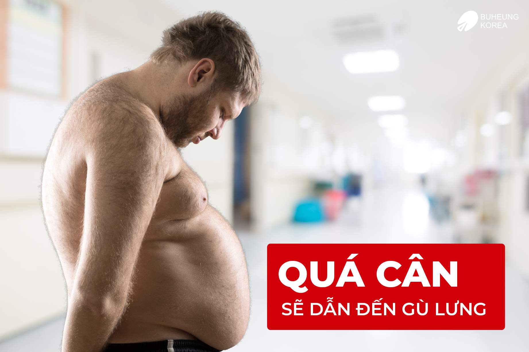 Minh họa thừa cân béo phì gây gù lưng, cong lưng