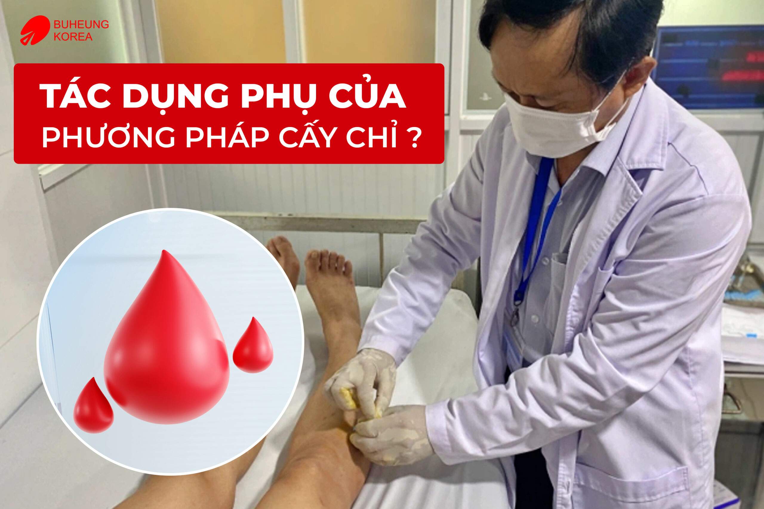 Minh họa tác dụng phụ của cấy chỉ