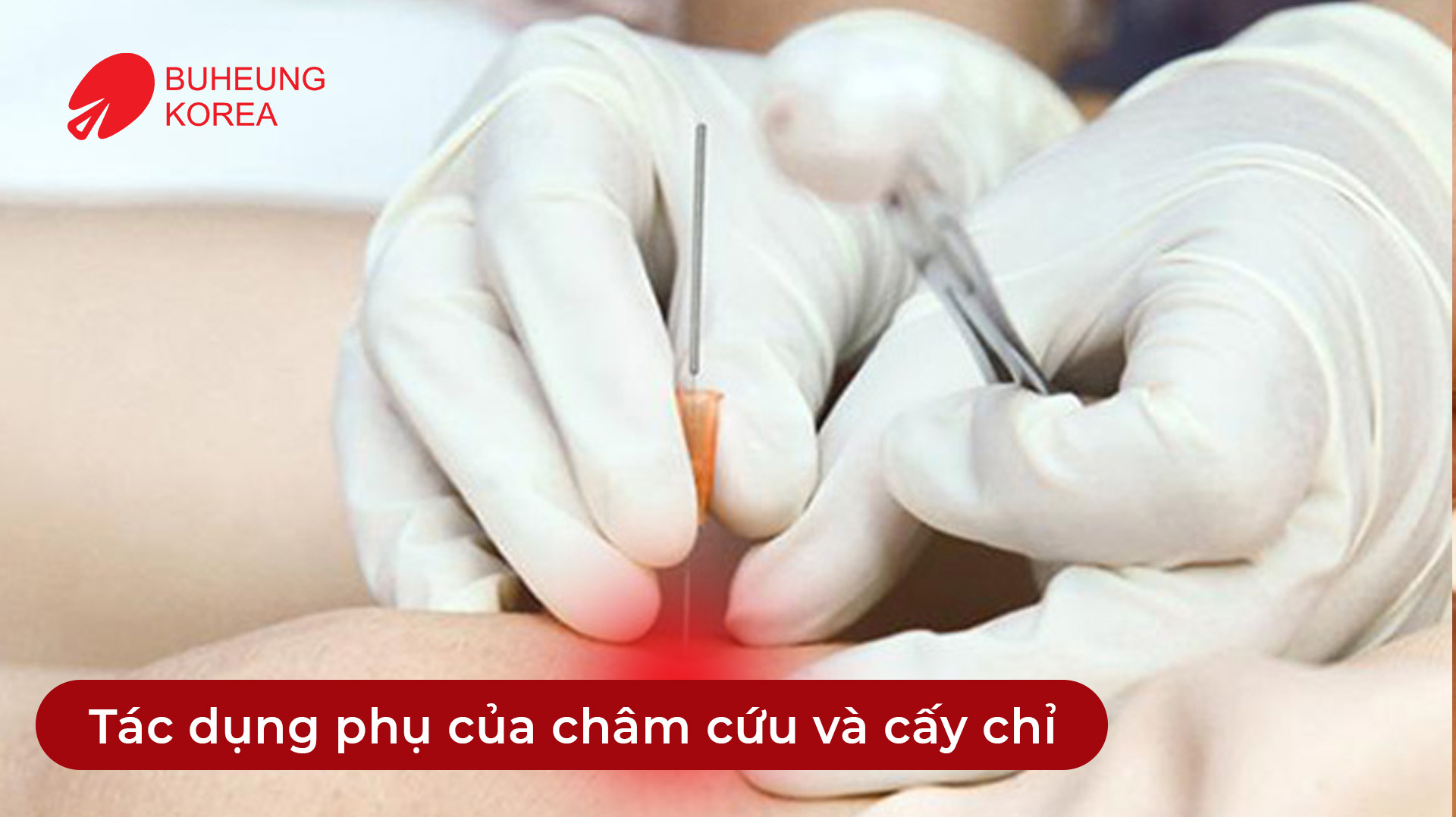 Minh họa tác dụng phụ của châm cứu và cấy chỉ