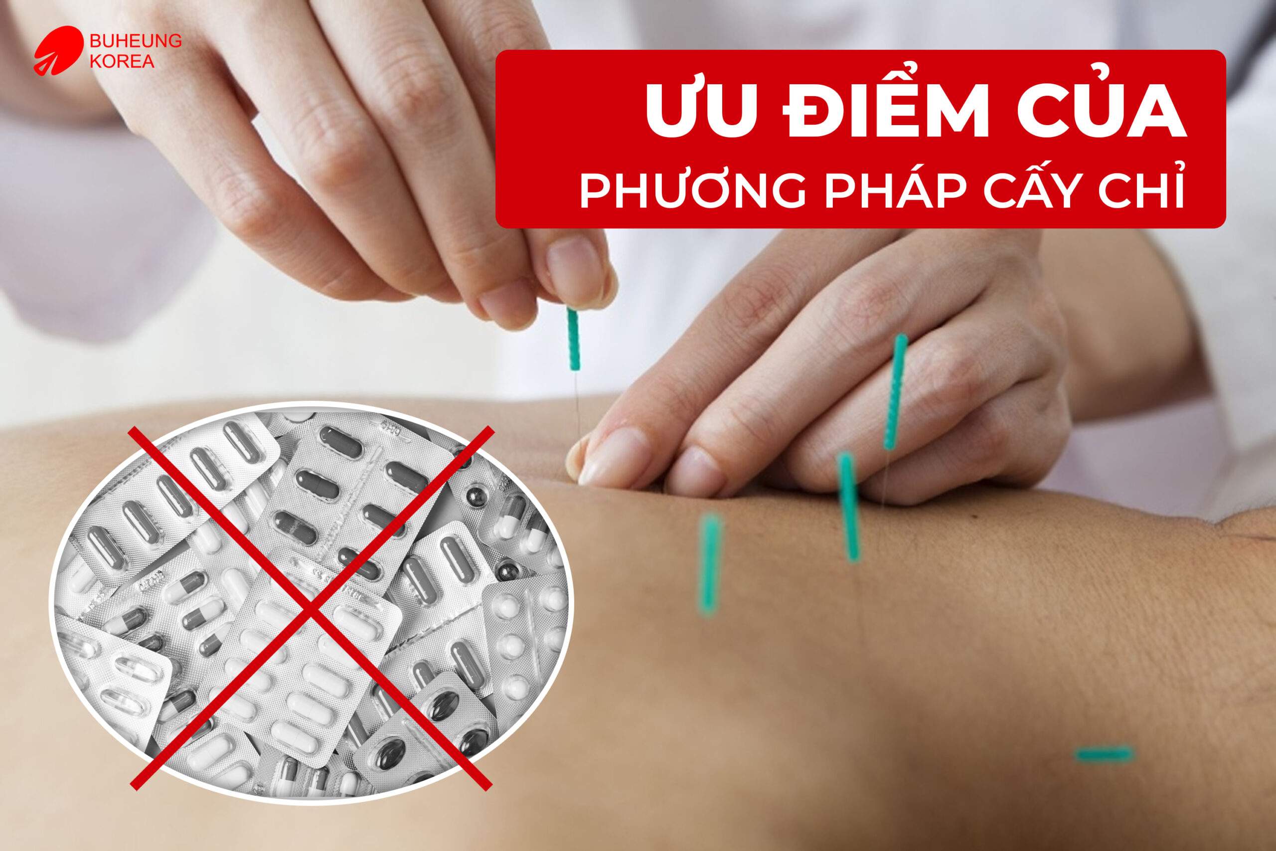 Minh họa ưu điểm của cấy chỉ