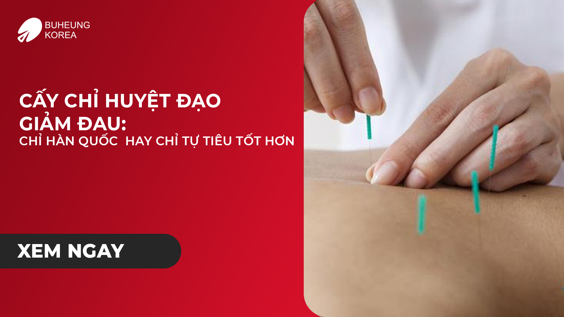 Cấy Chỉ Huyệt Đạo Giảm Đau: Chỉ Hàn Quốc Hay Chỉ Tự Tiêu Tốt Hơn 1 Minh họa cấy chỉ hàn quốc hay chỉ tự tiêu tốt hơn