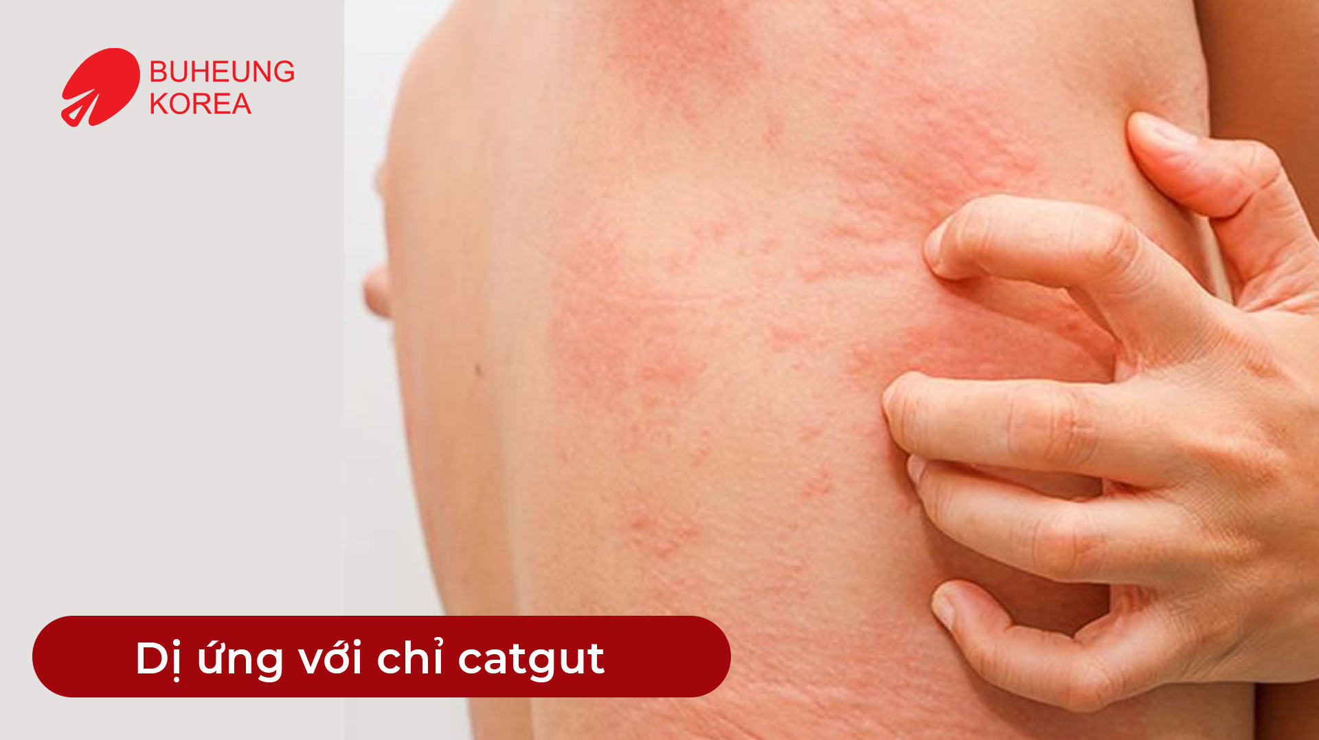Minh họa dị ứng chỉ catgut