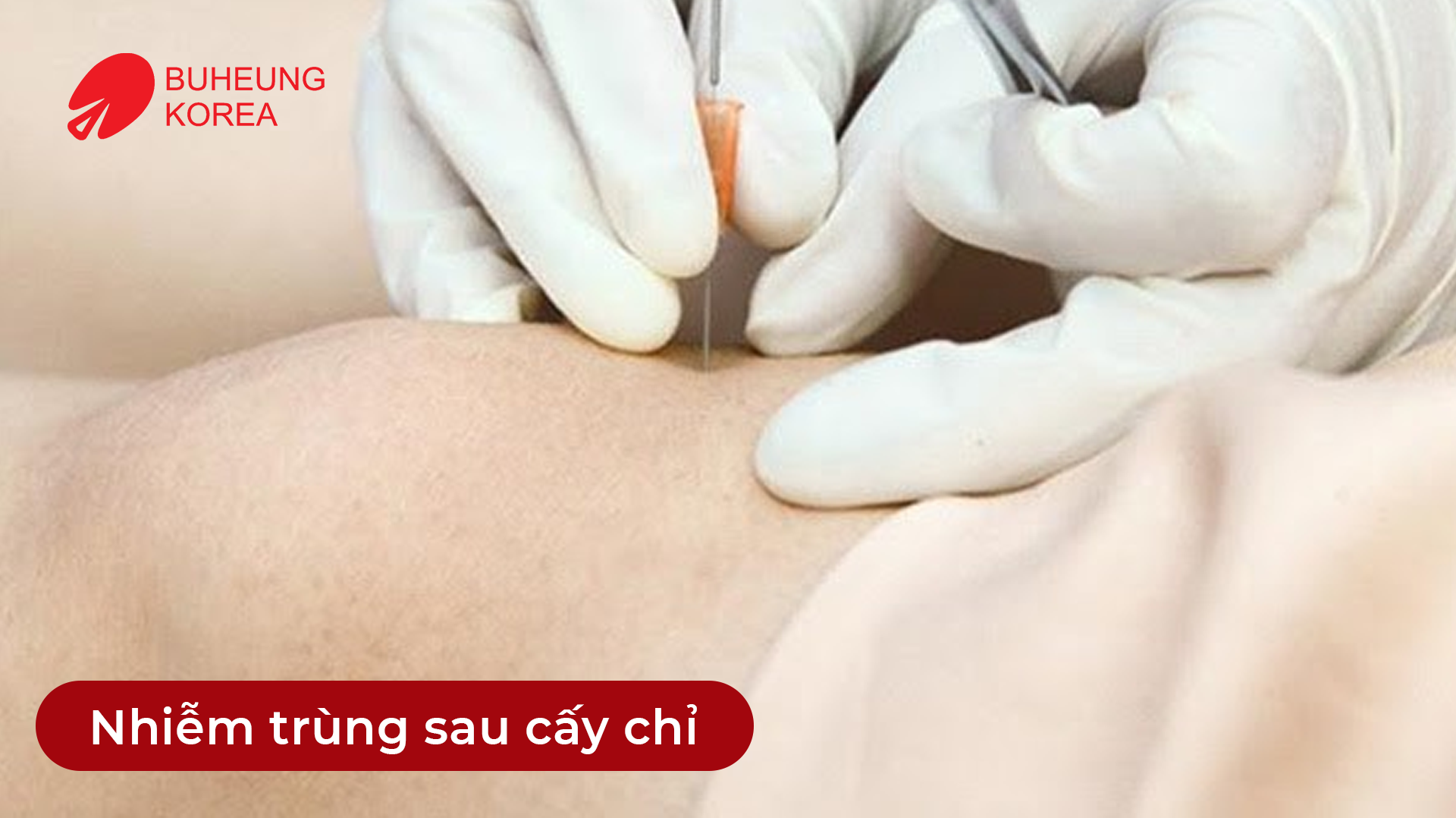 Minh họa nhiễm trùng sau cấy chỉ