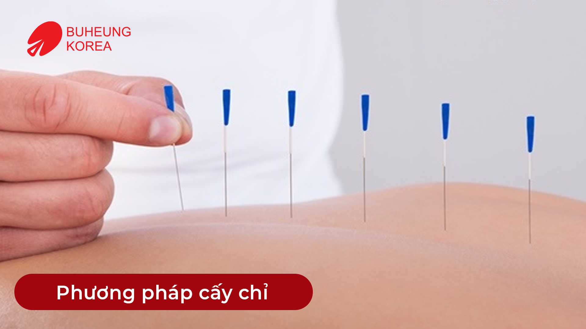 Cấy Chỉ Huyệt Đạo Giảm Đau: Chỉ Hàn Quốc Hay Chỉ Tự Tiêu Tốt Hơn 2 Minh họa phương pháp cấy chỉ