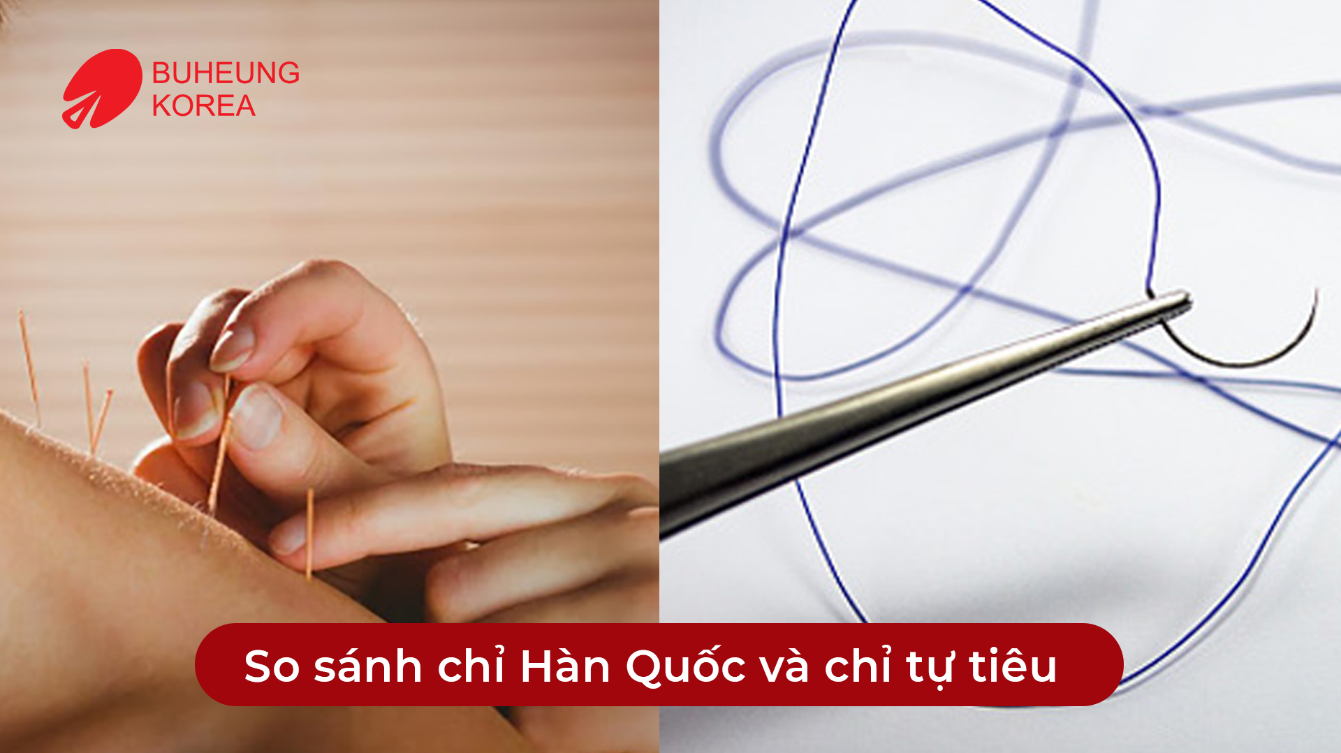 Cấy Chỉ Huyệt Đạo Giảm Đau: Chỉ Hàn Quốc Hay Chỉ Tự Tiêu Tốt Hơn 3 Minh họa so sánh chỉ hàn quốc và chỉ tự tiêu