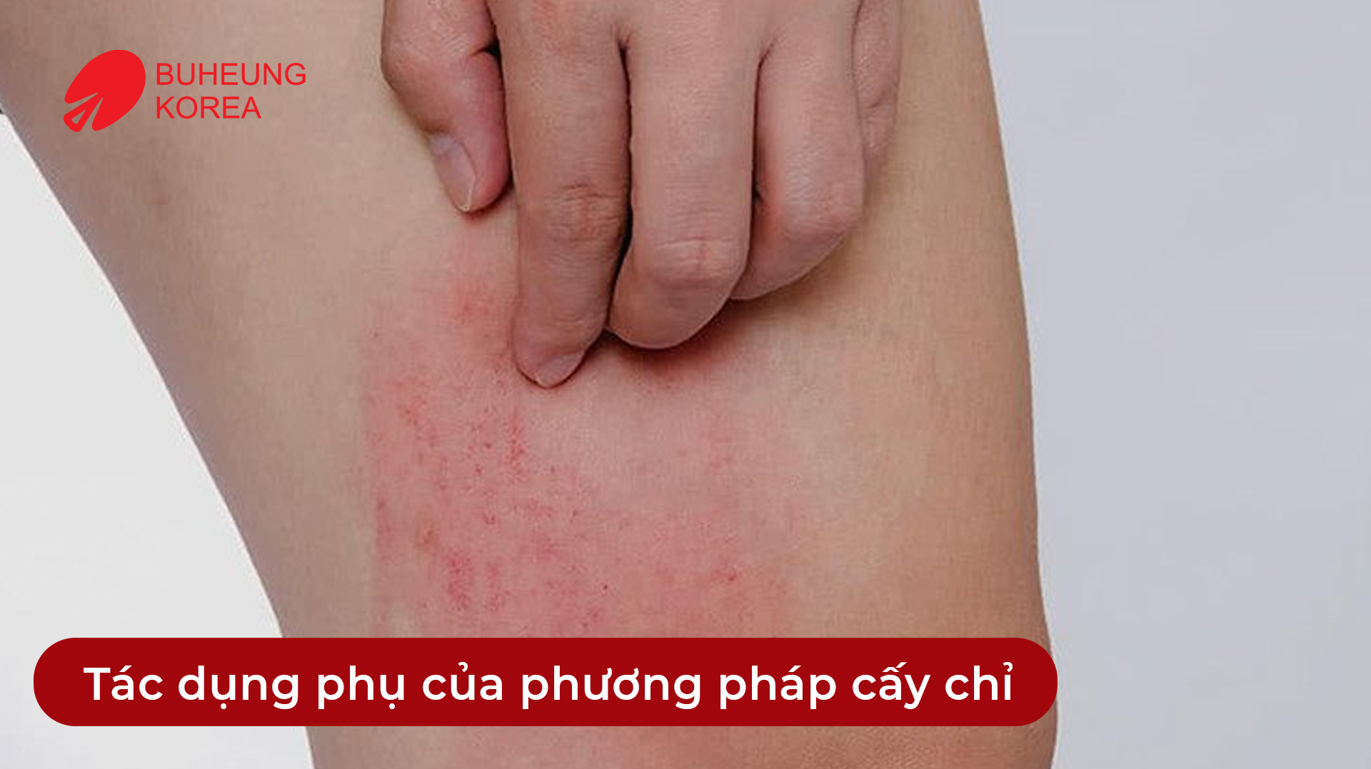 Cấy Chỉ Huyệt Đạo Giảm Đau: Chỉ Hàn Quốc Hay Chỉ Tự Tiêu Tốt Hơn 4 Minh họa tác dụng phụ cấy chỉ