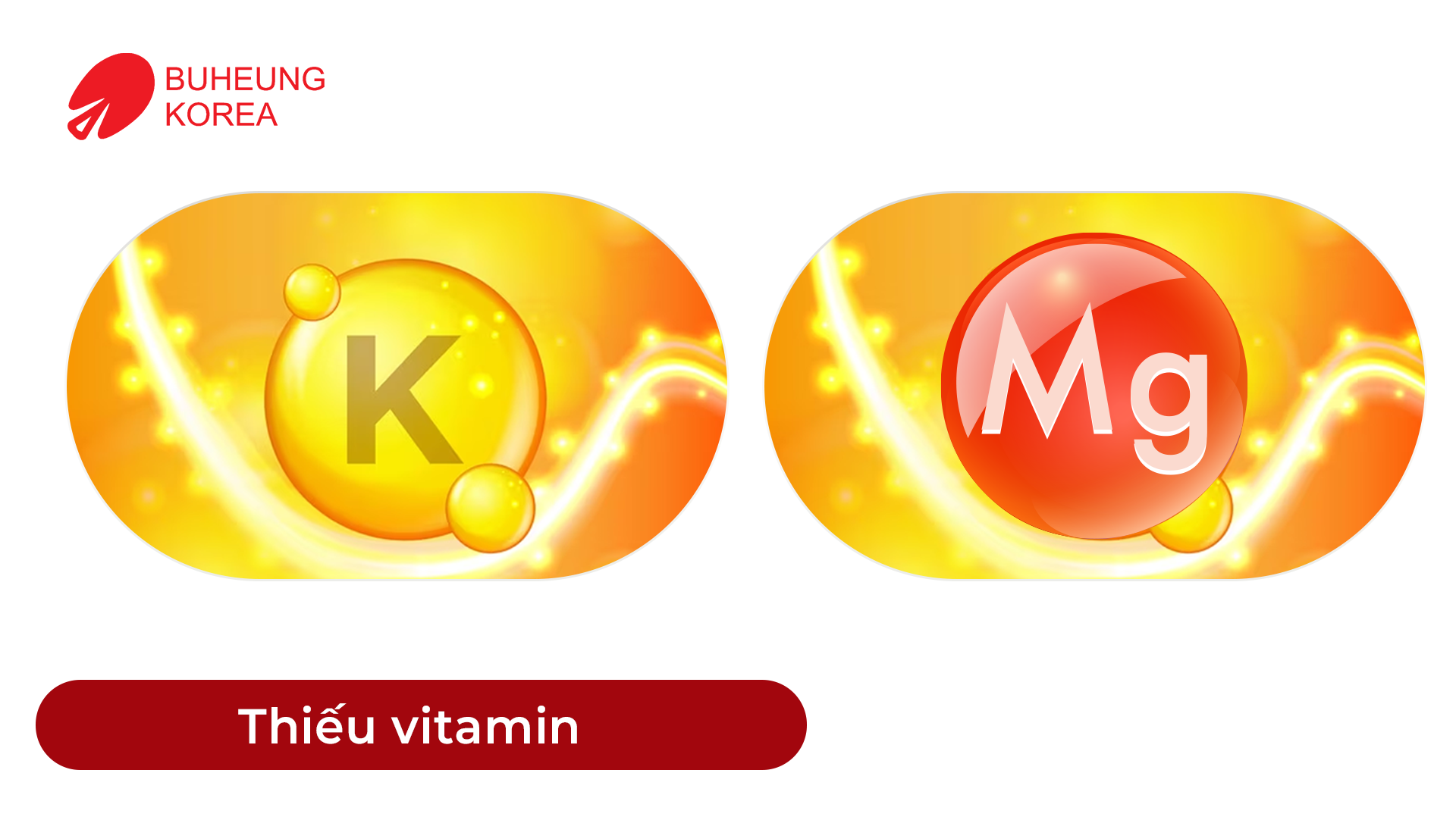 Minh họa căng cơ do thiếu vitamin