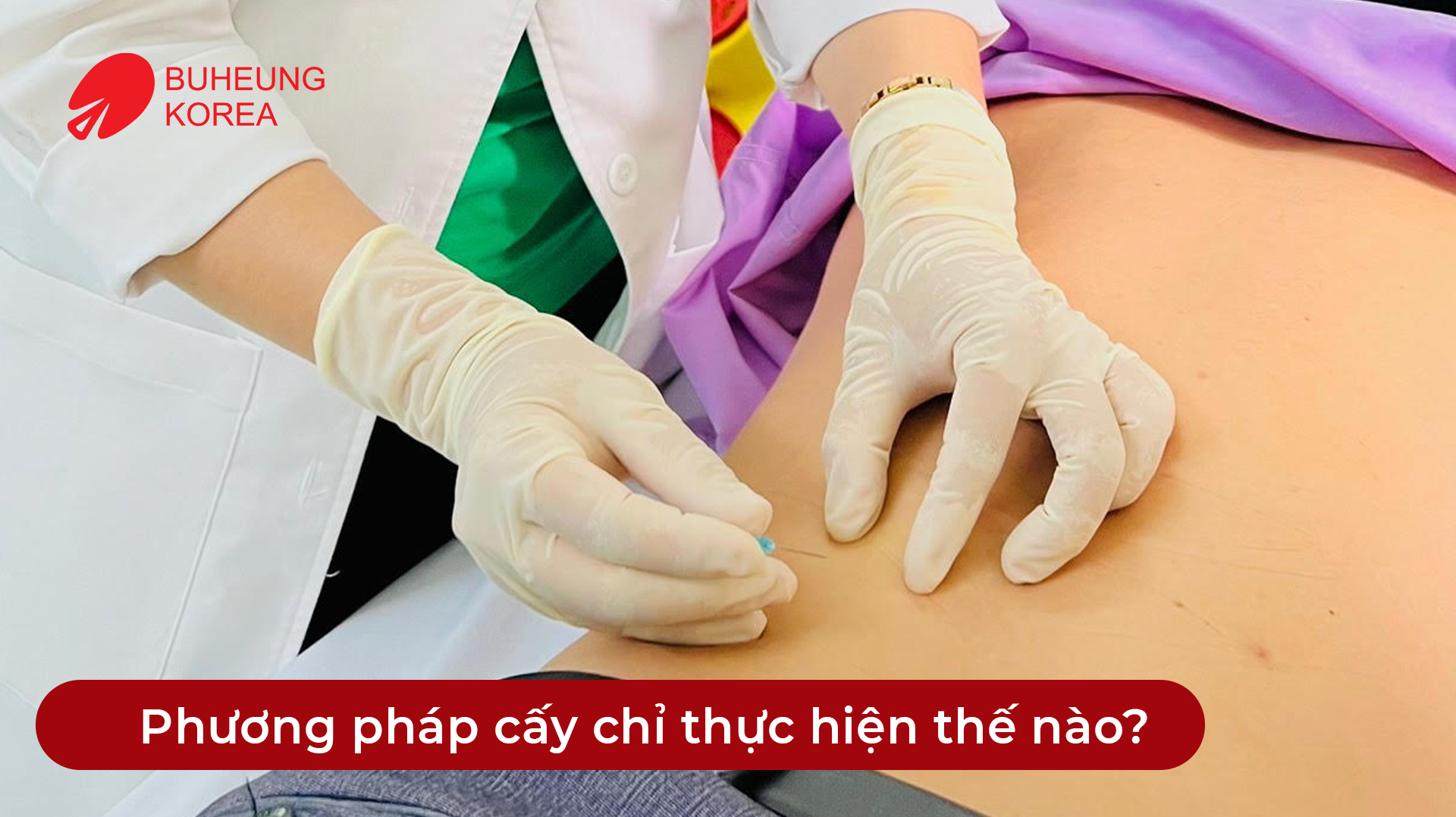 Minh họa cách thực hiện cấy chỉ
