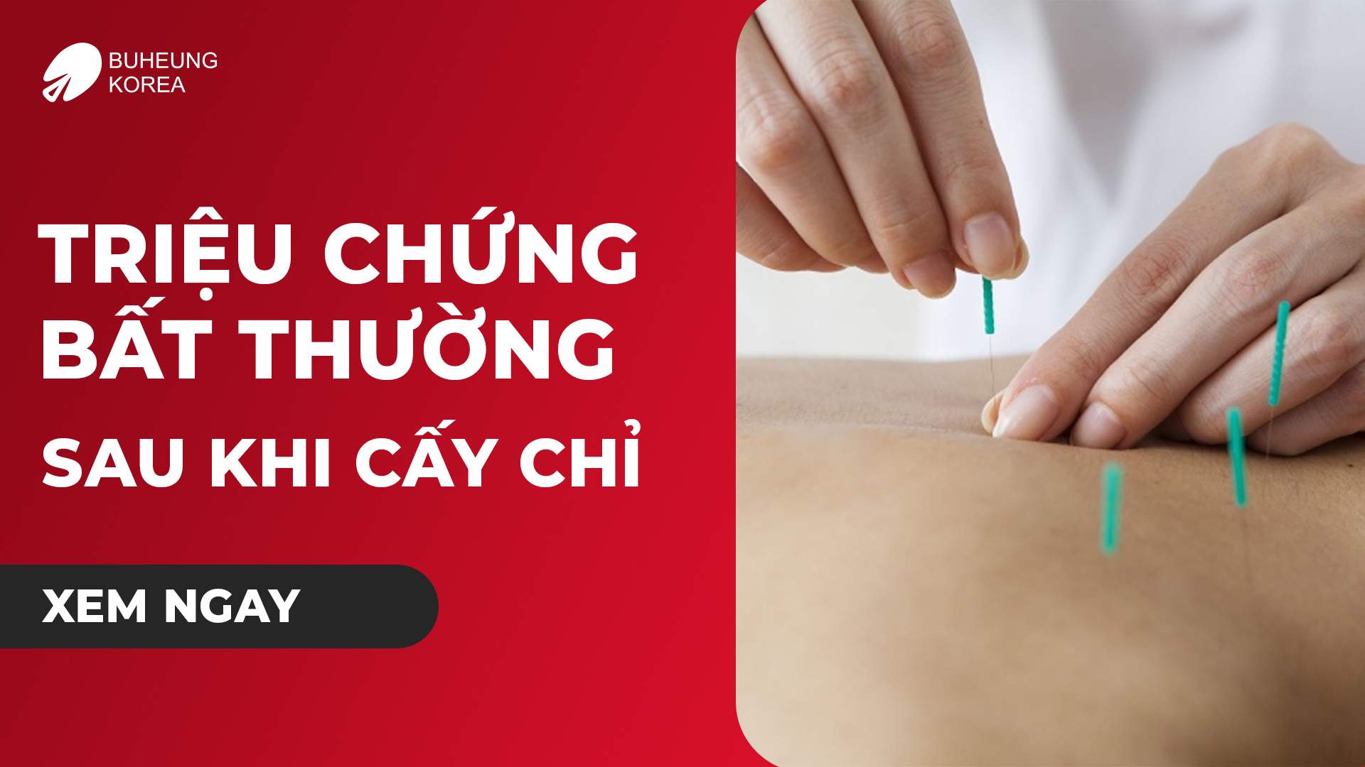 7 Triệu Chứng Bất Thường Sau Khi Cấy Chỉ Cần Theo Dõi 1 Minh họa triệu chứng bất thường sau cấy chỉ