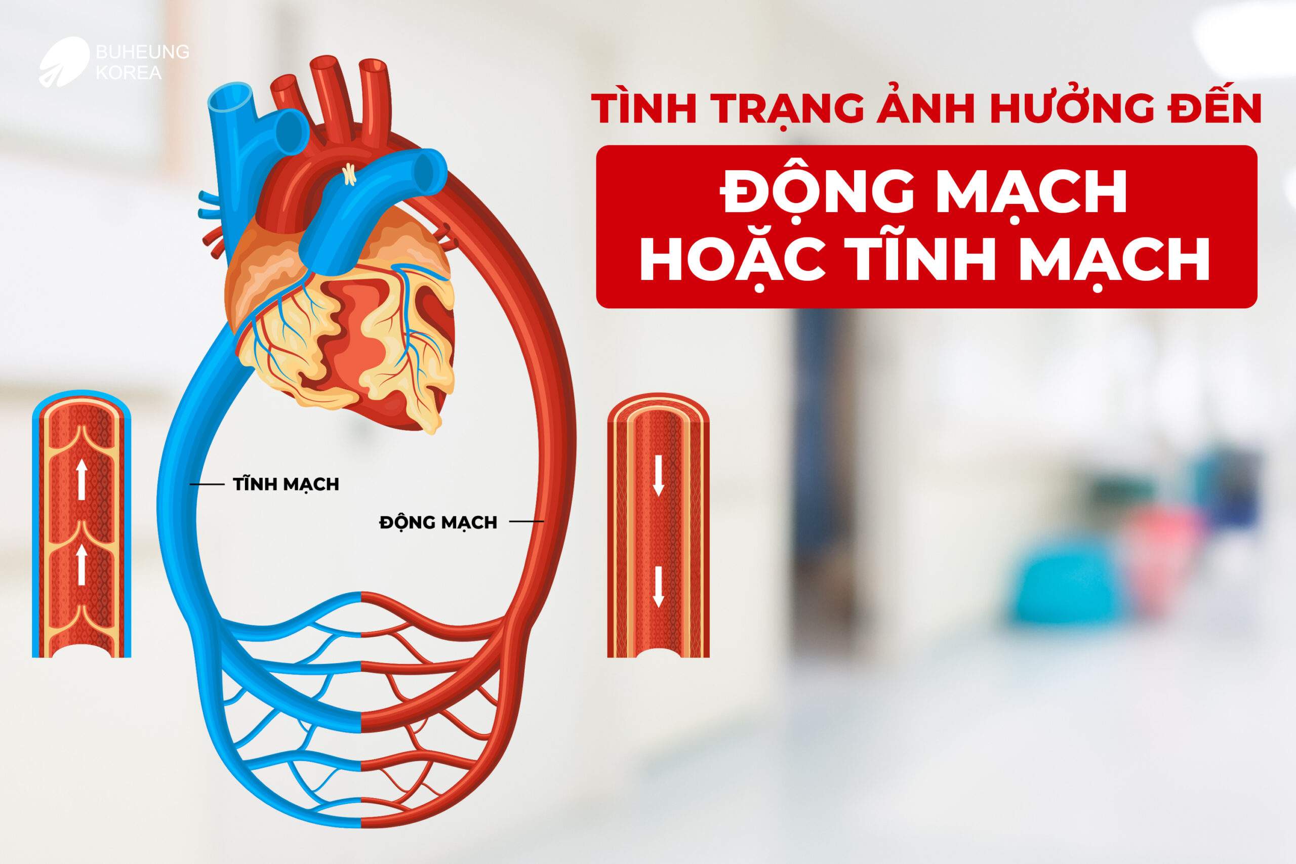 Minh họa động mạch hoặc tĩnh mạch gây tuần hoàn máu kém