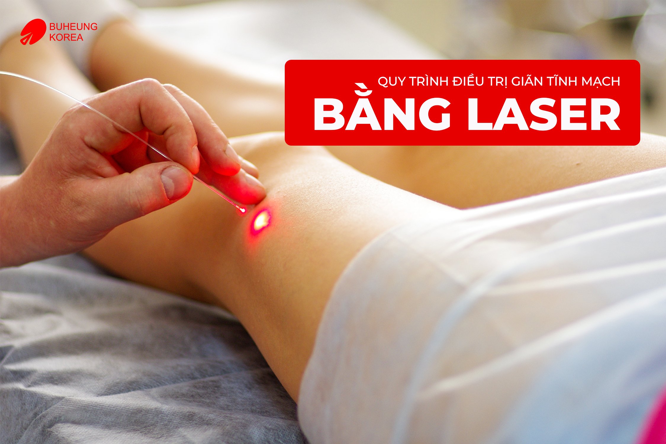 Chi Phí Điều Trị Giãn Tĩnh Mạch Bằng Laser 4 Chi Phí Điều Trị Giãn Tĩnh Mạch Bằng Laser 4
