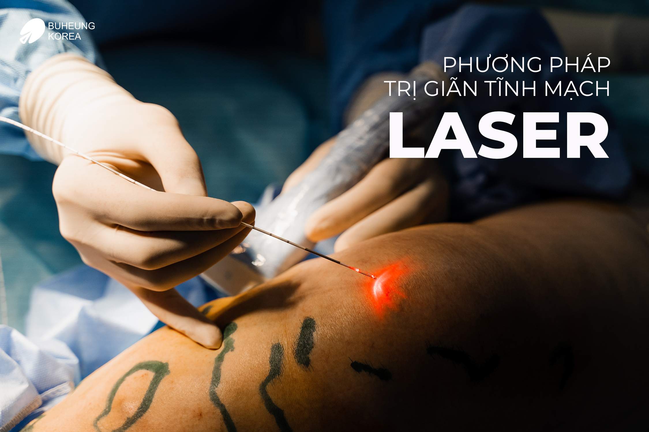 Chi Phí Điều Trị Giãn Tĩnh Mạch Bằng Laser 3 Chi Phí Điều Trị Giãn Tĩnh Mạch Bằng Laser 3