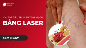 Chi Phí Điều Trị Giãn Tĩnh Mạch Bằng Laser 1