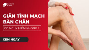Giãn Tĩnh Mạch Bàn Chân Có Nguy Hiểm Không? 70