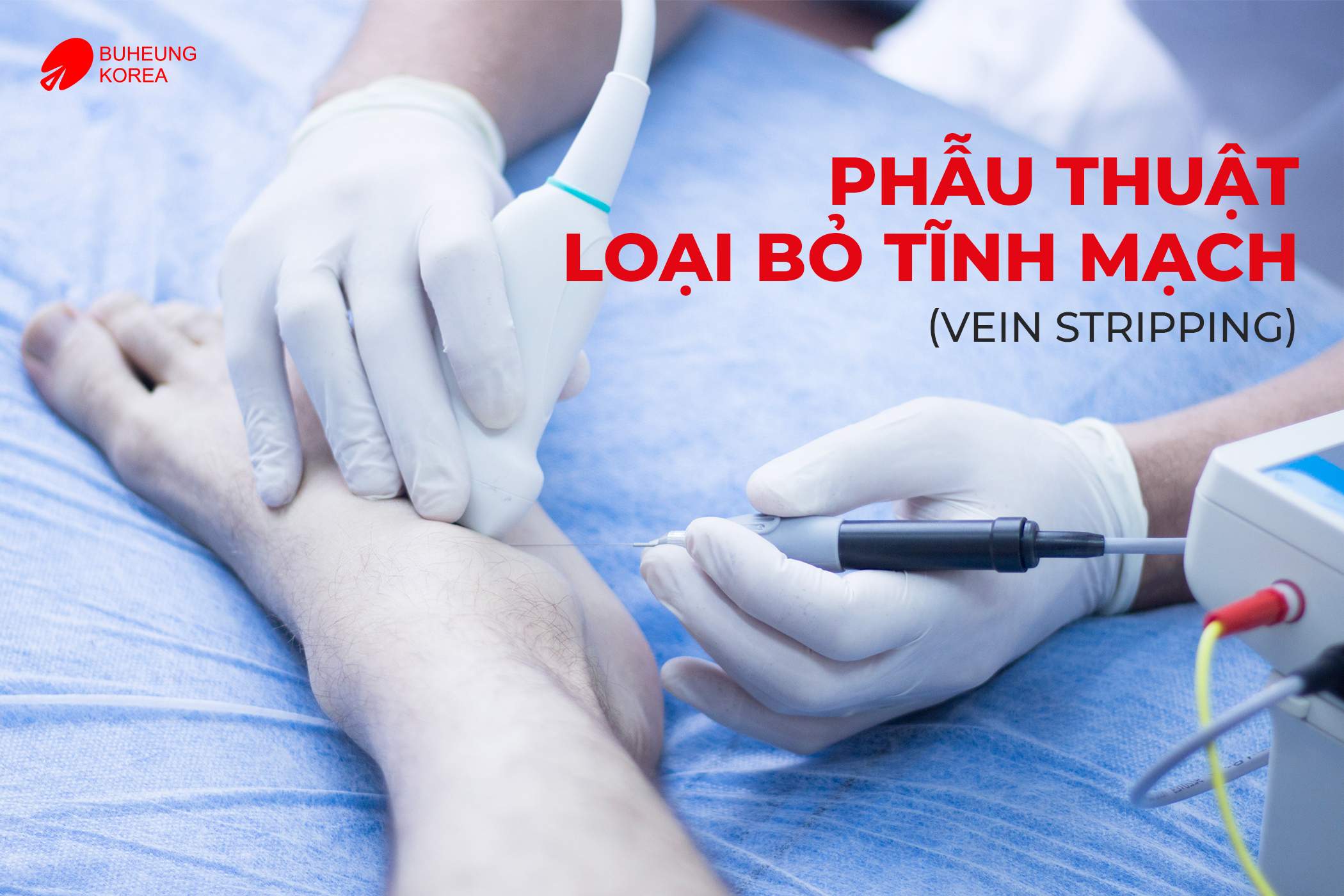 Giãn Tĩnh Mạch Chi Dưới Có Chữa Được Không? 4