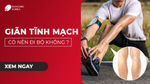 Giãn Tĩnh Mạch Chân Có Nên Đi Bộ Không? 57