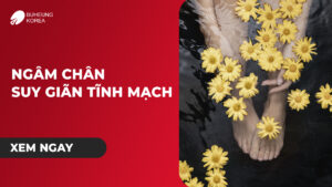 Hướng Dẫn Ngâm Chân Trị Suy Giãn Tĩnh Mạch Hiệu Quả 5