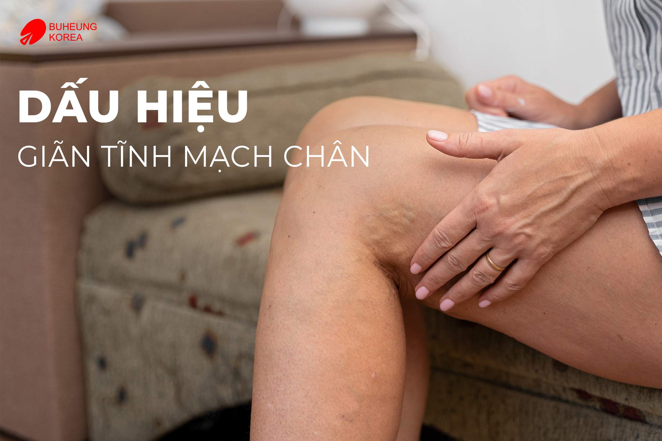 Nguyên Nhân Và Cách Trị Giãn Tĩnh Mạch Chân Tại Nhà 1
