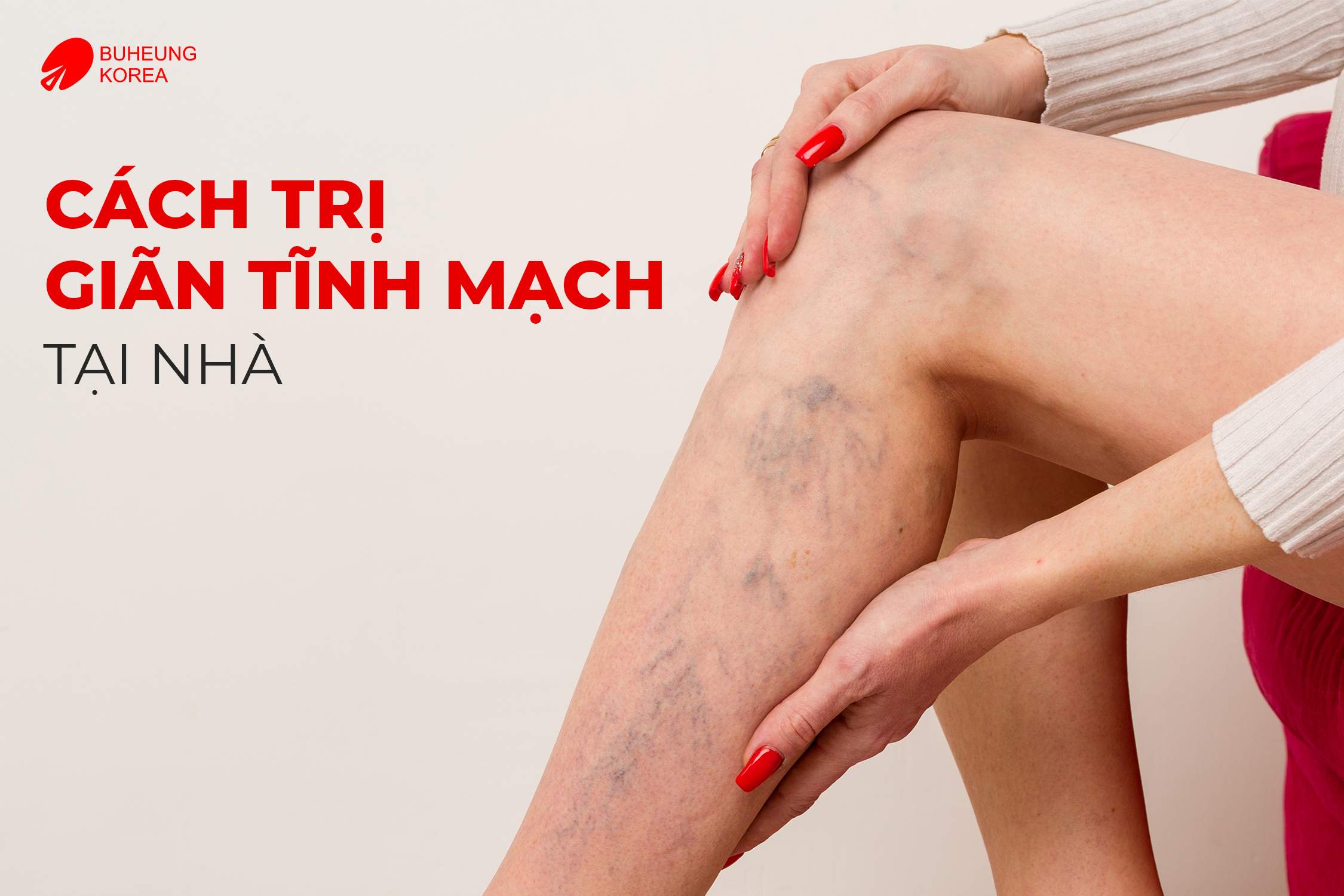 Nguyên Nhân Và Cách Trị Giãn Tĩnh Mạch Chân Tại Nhà 4