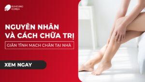 Nguyên Nhân Và Cách Trị Giãn Tĩnh Mạch Chân Tại Nhà 65