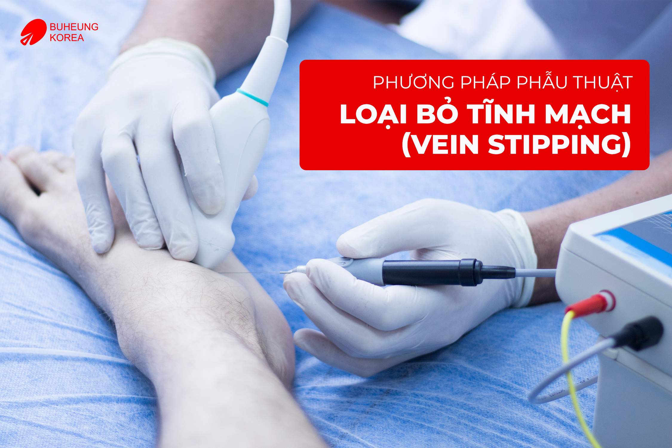 Chi Phí Điều Trị Giãn Tĩnh Mạch Bằng Laser 1 Chi Phí Điều Trị Giãn Tĩnh Mạch Bằng Laser 1