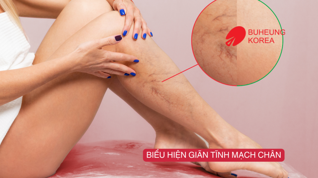 Giãn Tĩnh Mạch Sử Dụng Máy Massage Chân Được Không? 2