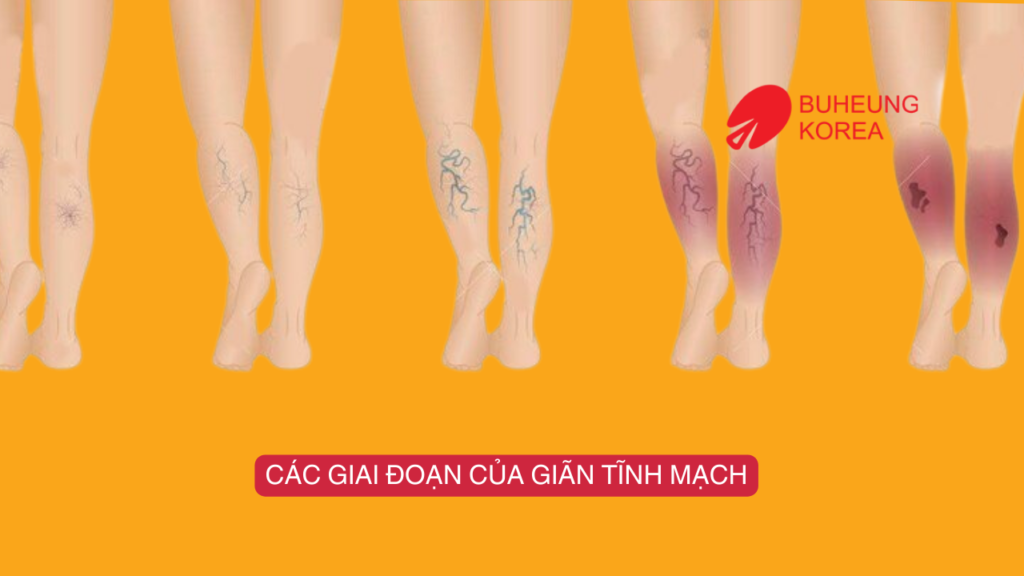 Giãn Tĩnh Mạch Sử Dụng Máy Massage Chân Được Không? 4